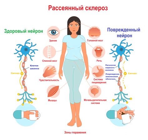 рассеянный склероз передается по наследству|Рассеянный склероз – что это, причины,。